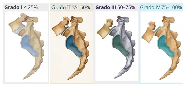 Listesis